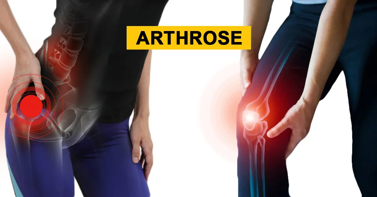 Arthrose
